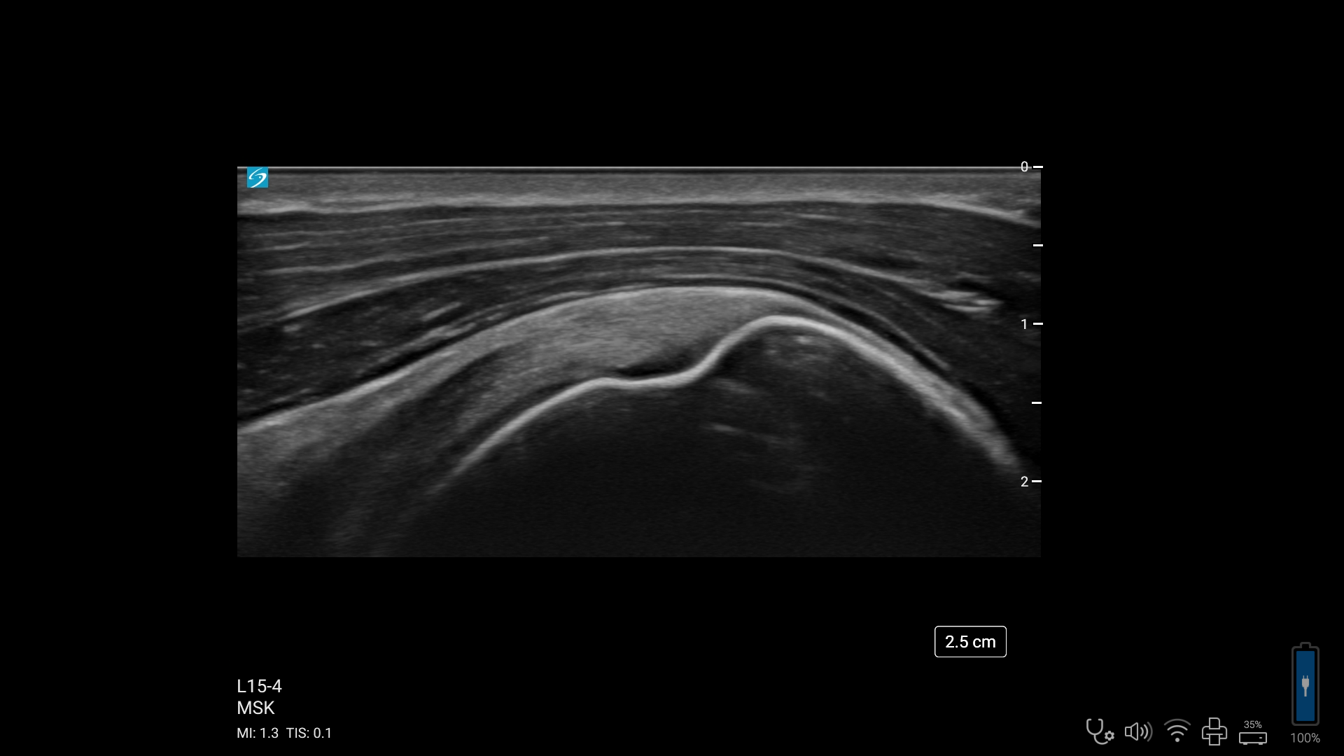 Sonosite ZX | FUJIFILM Sonosite